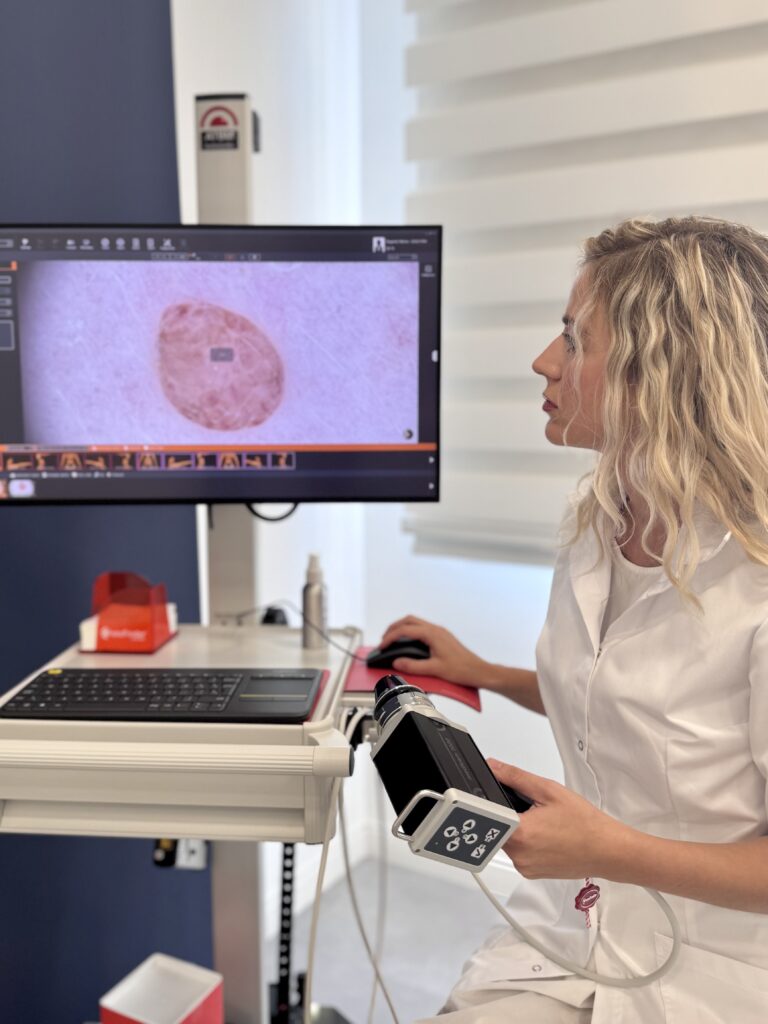 FotoFinder pregled kože